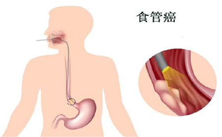 食道癌的症状及怎样诊断