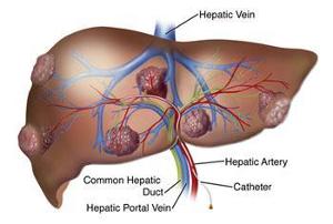 原发性肝癌的病因