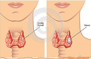甲状腺肿瘤高发的七大因素