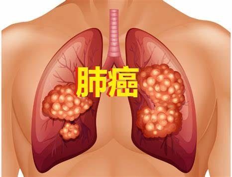 欧盟批准Imfinzi(英飞凡)：一线治疗普遍期小细胞肺癌(ES-SCLC)！_香港济民药业