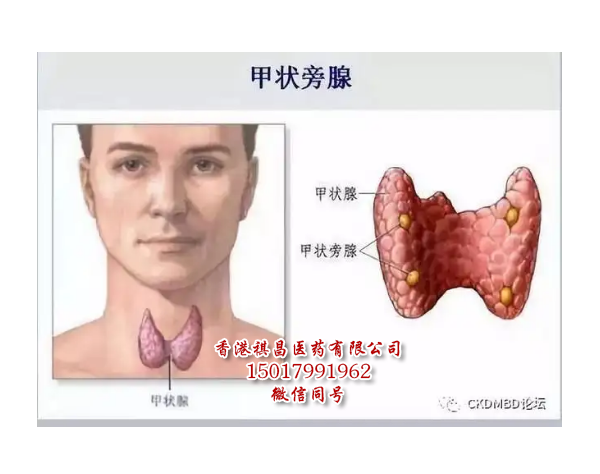 甲状旁腺激素Natpara